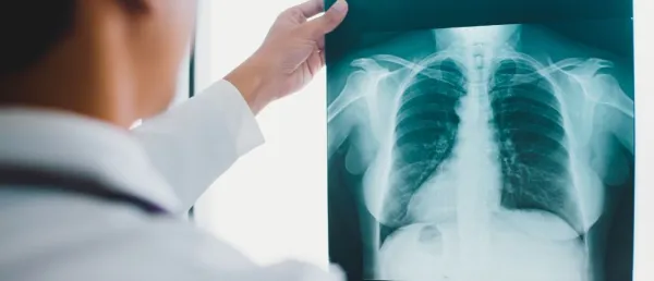 Fischer Medical Subsidiary to Supply 250 AI-Enabled Portable X-Ray Systems to Indonesia